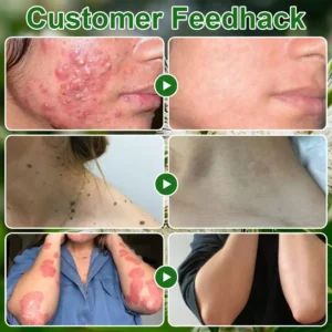 𝐓𝐞𝐚 𝐓𝐫𝐞𝐞 𝐎𝐢𝐥 𝐒𝐤𝐢𝐧 𝐓𝐫𝐞𝐚𝐭𝐦𝐞𝐧𝐭 𝐂𝐫𝐞𝐚𝐦 - Image 3
