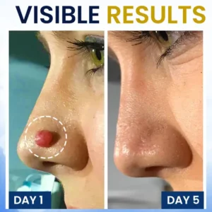 Skin Tag Cryo Treatment Spray - Image 6