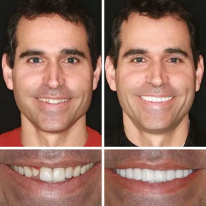 Advanced Customized Full Denture Set - Image 3