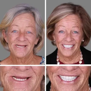 Advanced Customized Full Denture Set - Image 2