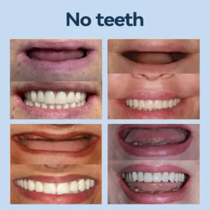 👧🏻🔆- 𝐏𝐫𝐞𝐦𝐢𝐮𝐦 𝐃𝐞𝐧𝐭𝐮𝐫𝐞- (✨Suitable for all mouth shapes, custom-made dentures for a perfect fit✨） - Image 7