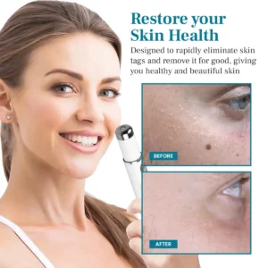 Mole and Wart Removal Laser Pen - Image 9