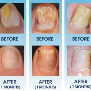 Nail Fungus Laser Treatment Device - Image 11