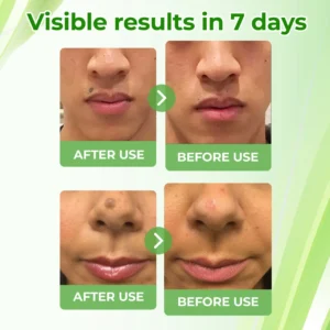 Natural Spot and Mole Removal Cream - Image 6