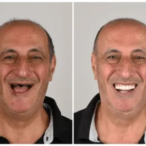 🦷 Custom-Fit Functional Dentures 😁 Smile with Confidence - Image 2