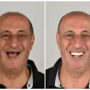 🦷 Custom-Fit Functional Dentures 😁 Smile with Confidence - Image 2
