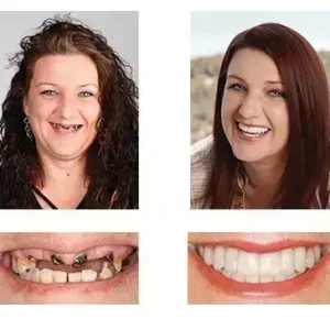 🦷 Custom-Fit Functional Dentures 😁 Smile with Confidence - Image 5
