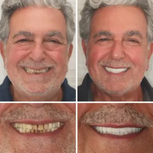 🦷Advanced Customized Full Denture Set🦷 - Image 7