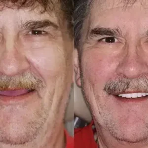 🦷Advanced Customized Full Denture Set🦷 - Image 8