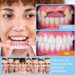 Geavanceerde op maat gemaakte volledige protheseset - Image 9