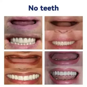 🦷𝐀𝐝𝐯𝐚𝐧𝐜𝐞𝐝 𝐂𝐮𝐬𝐭𝐨𝐦𝐢𝐳𝐞𝐝 𝐅𝐮𝐥𝐥 𝐃𝐞𝐧𝐭𝐮𝐫𝐞 𝐒𝐞𝐭🦷 (🌟Limited time discount last 30 minutes🌟)🌟🌟 - Image 7