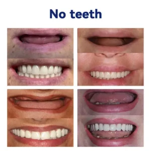 Premium Denture - Image 3