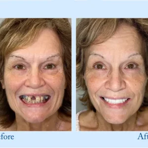 Premium Customized Full Denture Set🦷 - Image 2