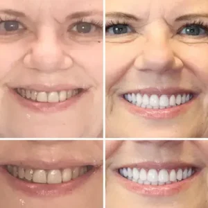 Set di protesi dentarie complete personalizzate avanzate🦷 - Image 9