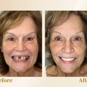 –🦷Advanced Customized Full Denture Set🦷 (⏰Limited time discount last 30 minutes⏰)💎💎 - Image 6