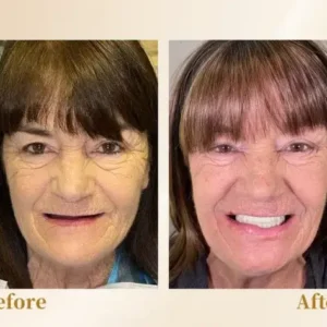 🦷Advanced Customized Full Denture Set🦷 (⏰Limited time discount last 30 minutes⏰)🚁🚁 - Image 10