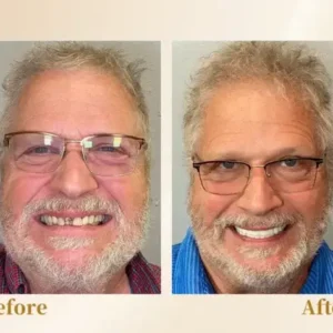 🦷Advanced Customized Full Denture Set🦷 (⏰Limited time discount last 30 minutes⏰)🚁🚁 - Image 11