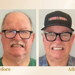 🦷Advanced Customized Full Denture Set🦷 (⏰Limited time discount last 30 minutes⏰)🚁🚁 - Image 5