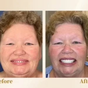 🦷Advanced Customized Full Denture Set🦷 (⏰Limited time discount last 30 minutes⏰)🚁🚁 - Image 7