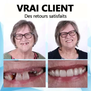 🎈Kit de prothèses dentaires en silicone (⏰Remise à durée limitée Dernières 30 minutes）⏰ - Image 6