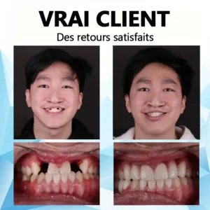 🎈Kit de prothèses dentaires en silicone (⏰Remise à durée limitée Dernières 30 minutes）⏰ - Image 7