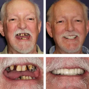 Custom-Fit Functional Dentures — Combination pack - Image 6