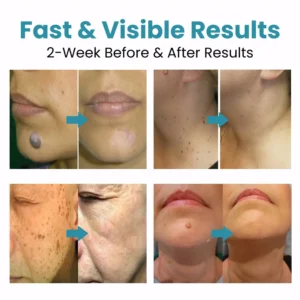 Non-Invasive Mole and Wart Removal Laser Pen - Image 2
