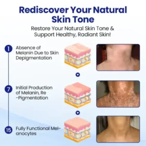Vitiligo Treatment Spray - Image 7