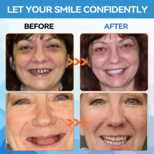 Silicone Reline Denture Set - Image 4