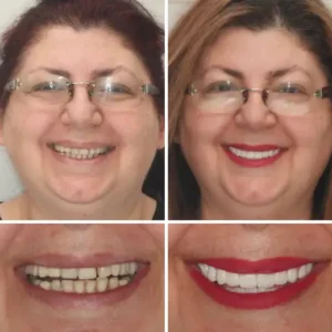 🦷Advanced Customized Full Denture Set🦷 - Image 9