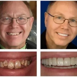 Custom-Fit Functional Dentures - Image 6