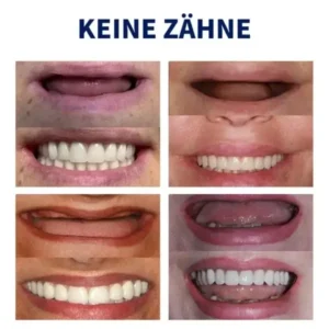 Fortgeschrittenes, maßgeschneidertes Vollprothesen-Set - Image 7
