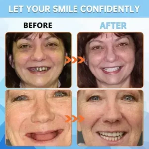 Adhesive teeth (upper and lower) - Image 5