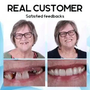 Silicone Reline Denture Set - Image 4