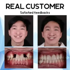 Premium Custom Silicone Denture Set - Image 12