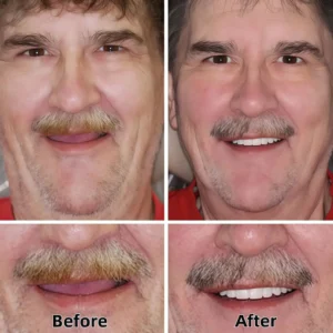 Advanced Custom-Fit Functional Dentures - Image 5