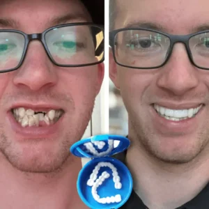 Affordable Denture Solution to Restore Your Natural Smile at Home - Image 3