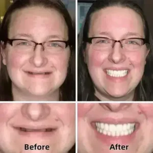 Advanced Custom-Fit Functional Dentures - Image 5