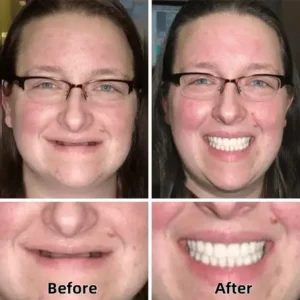 Advanced Custom-Fit Functional Dentures - Image 2