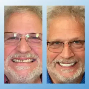 𝗙𝘂𝗻𝗰𝘁𝗶𝗼𝗻𝗮𝗹 𝗧𝗵𝗶𝗰𝗸𝗲𝗻𝗲𝗱 𝗗𝗲𝗻𝘁𝘂𝗿𝗲𝘀 - Image 5