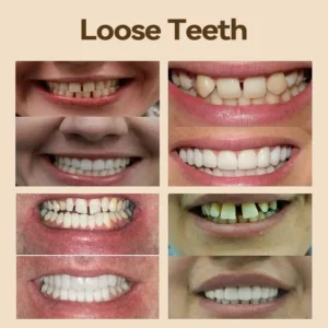 🐱‍🐉💦- 𝐏𝐫𝐞𝐦𝐢𝐮𝐦 𝐃𝐞𝐧𝐭𝐮𝐫𝐞- (✨Suitable for all mouth shapes, custom-made dentures for a perfect fit✨） - Image 6