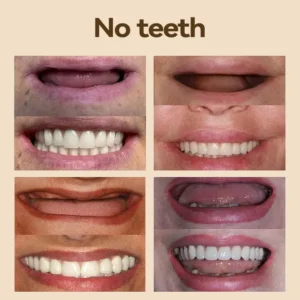 🐱‍🐉💦- 𝐏𝐫𝐞𝐦𝐢𝐮𝐦 𝐃𝐞𝐧𝐭𝐮𝐫𝐞- (✨Suitable for all mouth shapes, custom-made dentures for a perfect fit✨） - Image 7