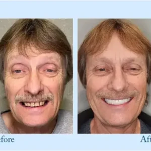 Dentures Set - Image 9