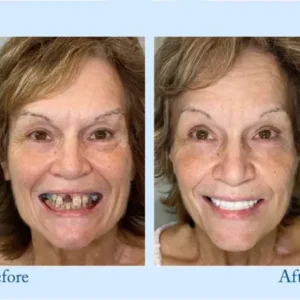 Full Dentures - Image 12