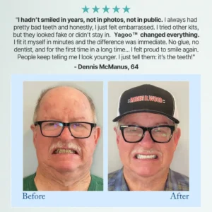 🦷Advanced Customized Full Denture Set🦷 (🔥10,000+ Sold In Last 30 Day) - Image 13