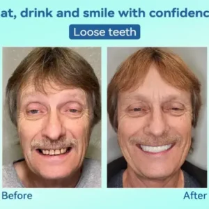 💎𝐏𝐫𝐞𝐦𝐢𝐮𝐦 𝐃𝐞𝐧𝐭𝐮𝐫𝐞(🦷𝐋𝐢𝐦𝐢𝐭𝐞𝐝 𝐭𝐢𝐦𝐞 𝐝𝐢𝐬𝐜𝐨𝐮𝐧𝐭 𝐋𝐚𝐬𝐭 𝟑𝟎 𝐦𝐢𝐧𝐮𝐭𝐞𝐬🦷) - Image 7