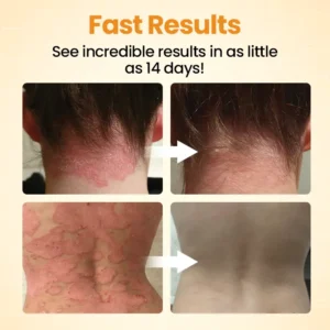 BeeLieves Psoriasis Repair Ointment - Image 3