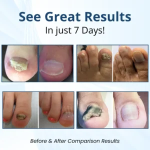 Fungal Nail Patches - Image 4