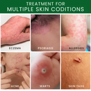 Tea Tree Oil Skin Treatment Cream - Image 6