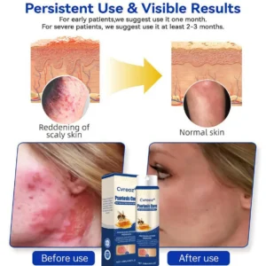 Psoriasis Cure Bee Venom Treatment Spray - Image 4